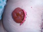 A picture of a loop colostomy