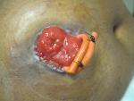 A picture of a loop ileostomy