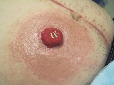 A picture of skin around a stoma with an allergic reaction to ostomy bag adhesive