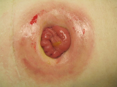 A picture of denuded peristomal skin on a loop ileostomy patient