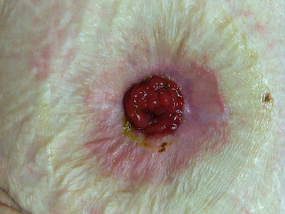 A picture of skin irritation around a stoma 
