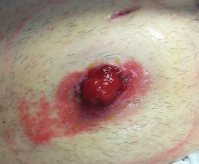 A picture of skin damage around the peristomal skin due to an incorrect bag pouching system fit