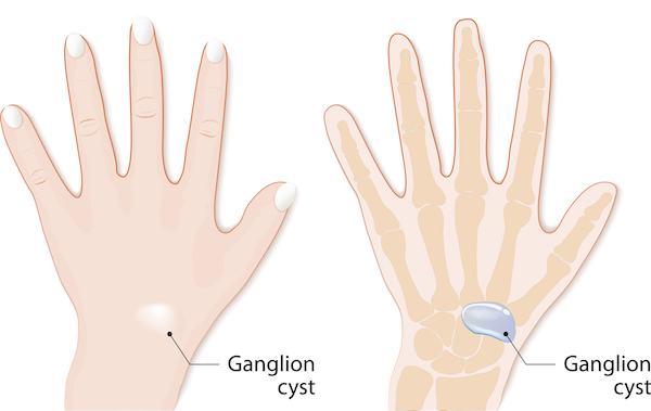 Diagram of a ganglion cyst