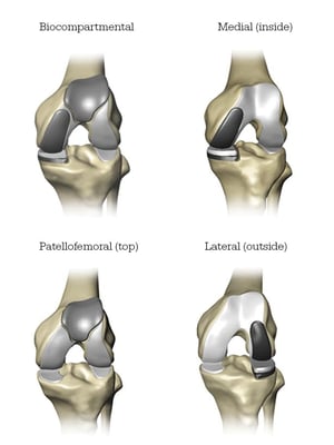Mako Partial Knee areas