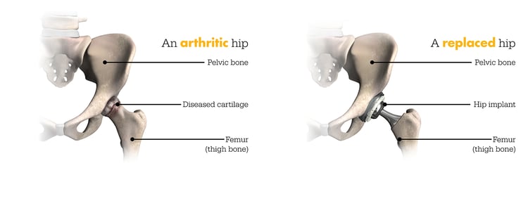 Mako Robotic Arm - Arthritic vs Replaced hip