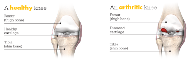 Mako Total Knee - Healthy vs Arthritic knee