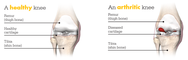 A) Mako robot for total knee arthroplasty. (B) Mako's computer