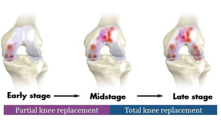 Total knee vs partial Knee