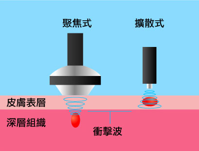 shockwave treatment difference