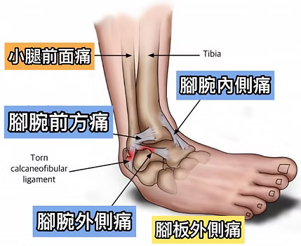 sprained ankle pain spots