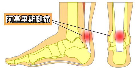 sprained ankle pain spots